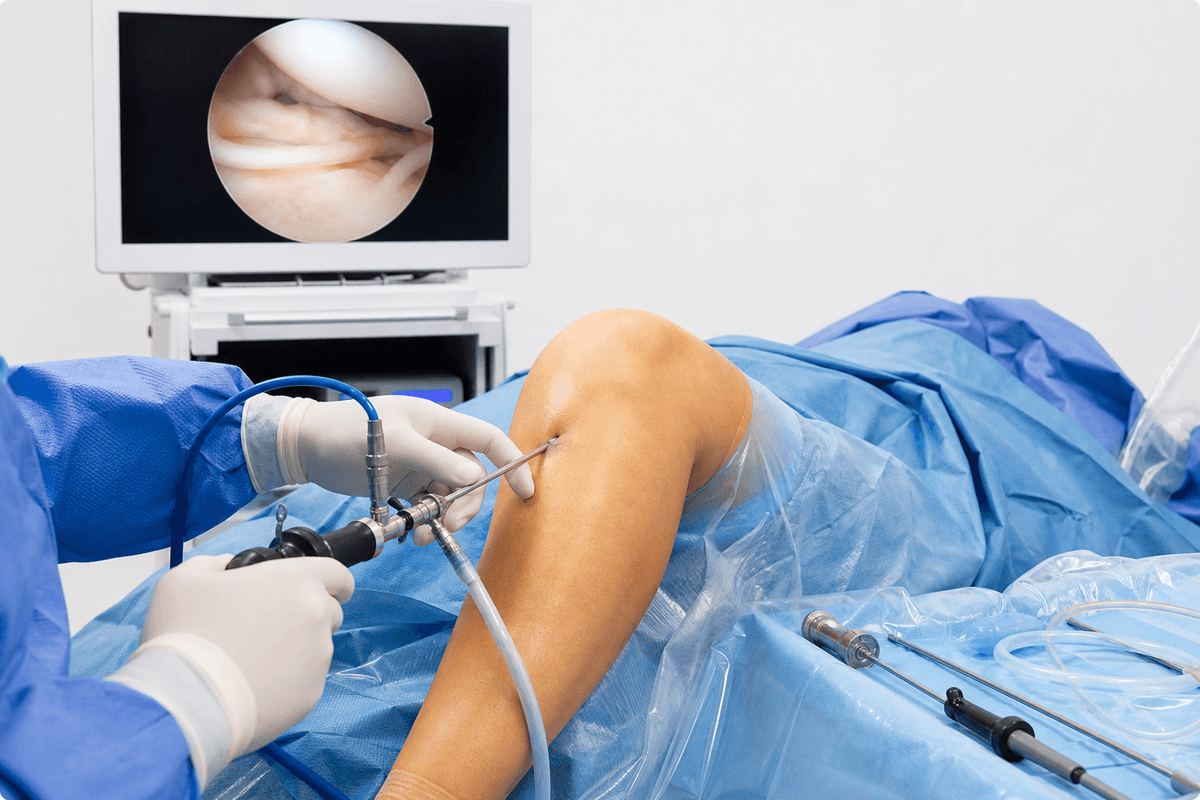 Arthroscopic Surgeries - Knee
